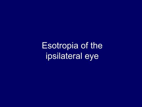 Horizontal Gaze Palsy