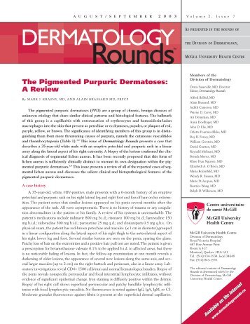 The Pigmented Purpuric Dermatoses - Dermatologyrounds.ca