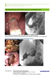 TRANSGASTRiSCh-RETROPERiTONEAlE NEkROSEkTOmiE