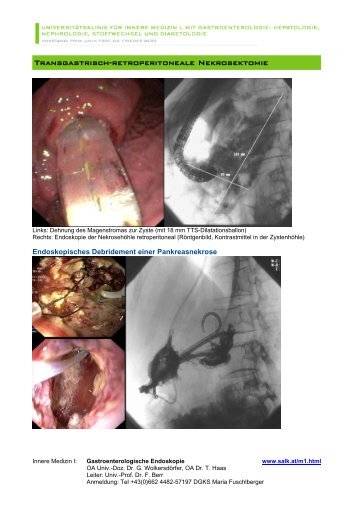 TRANSGASTRiSCh-RETROPERiTONEAlE NEkROSEkTOmiE