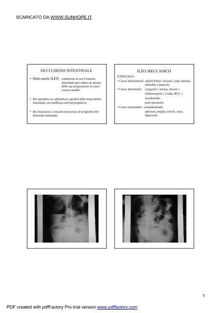 OCCLUSIONE INTESTINALE BIS - SunHope.it