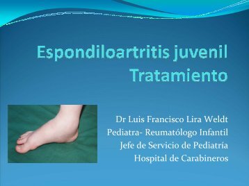 Espondiloartritis juveniles Tratamiento