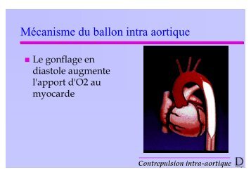 MÃ©canisme du ballon intra aortique - reannecy.org