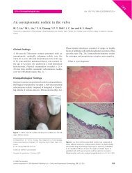 An asymptomatic nodule in the vulva