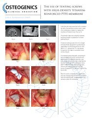 The use of tenting screws with high-density titanium ... - Osteogenics