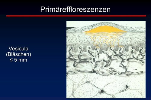 Erythem Erosion Kruste Blasen Schuppung - Universitätsklinikum ...