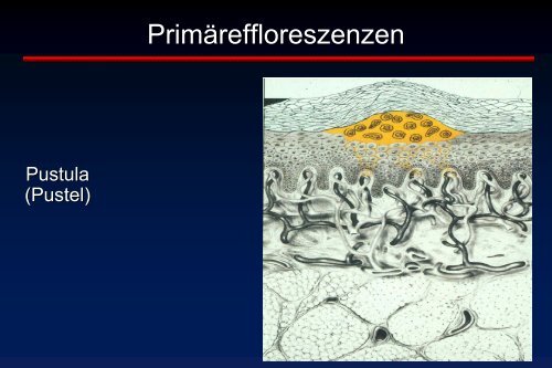 Erythem Erosion Kruste Blasen Schuppung - Universitätsklinikum ...