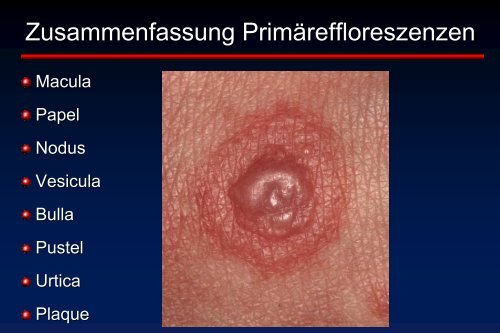 Erythem Erosion Kruste Blasen Schuppung - Universitätsklinikum ...