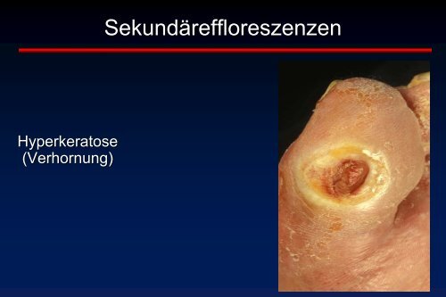 Erythem Erosion Kruste Blasen Schuppung - Universitätsklinikum ...