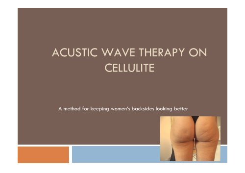 Cellulite - dr-ruemmelein