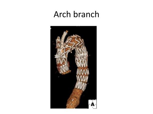 Aortic Arch Aneurysms â What Is Currently Available? - VascularWeb