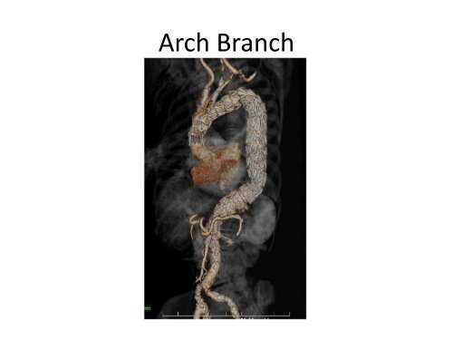 Aortic Arch Aneurysms â What Is Currently Available? - VascularWeb