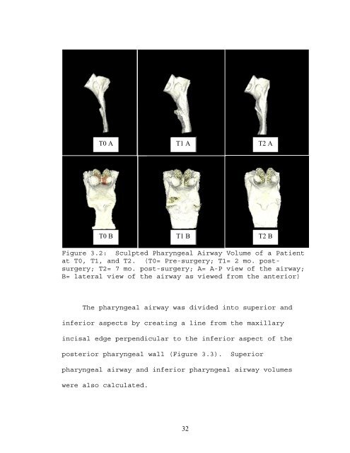 PHARYNGEAL AIRWAY VOLUME FOLLOWING ...