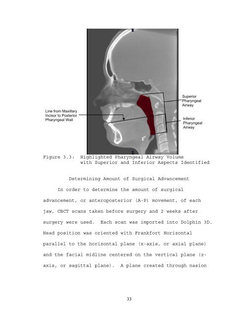 PHARYNGEAL AIRWAY VOLUME FOLLOWING ...