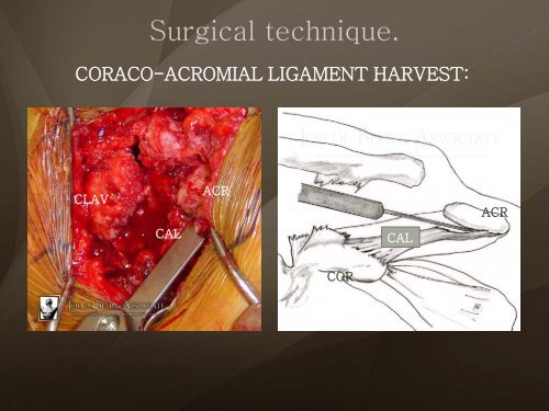 (Arthroscopic) Rotator Cuff Repair - ShoulderDoc.co.uk