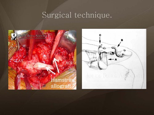 (Arthroscopic) Rotator Cuff Repair - ShoulderDoc.co.uk