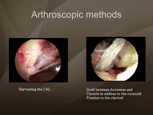 (Arthroscopic) Rotator Cuff Repair - ShoulderDoc.co.uk