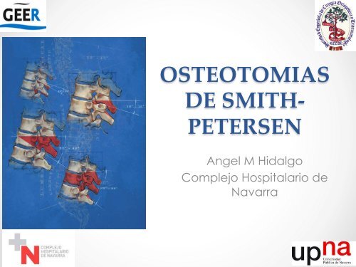 osteotomias-de-smith-petersen