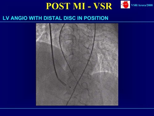 Deployment of ASD Device