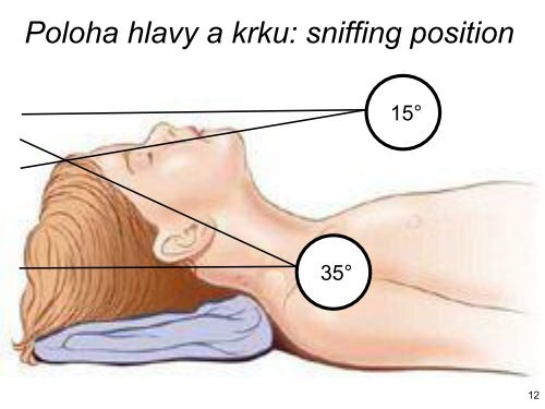 SellickÅ¯v hmat - ÄeskÃ¡ spoleÄnost anesteziologie, resuscitace a ...