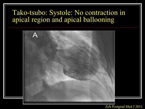 Management of Acute Cardiogenic Pulmonary Oedema