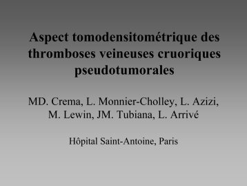 Aspect tomodensitomÃ©trique des thromboses veineuses cruoriques ...
