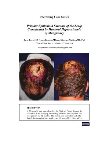 Primary Epithelioid Sarcoma of the Scalp Complicated by ... - ePlasty