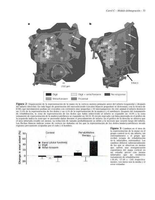 minimodulo sistema nervioso: accidente cerebrovascular - FMV