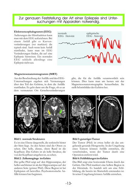 Informationstafeln Epilepsie - Krankenhaus Mara