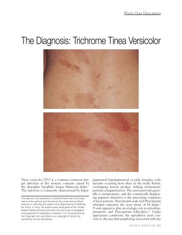 The Diagnosis: Trichrome Tinea Versicolor