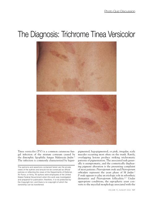 The Diagnosis: Trichrome Tinea Versicolor