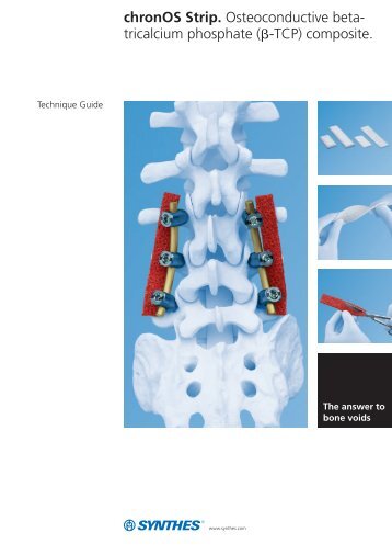 chronOS Strip. Osteoconductive beta- tricalcium ... - Synthes