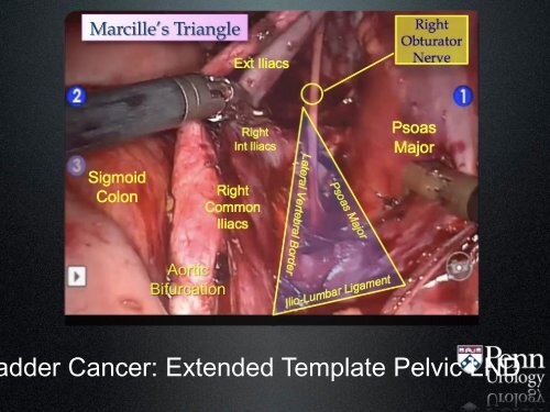 Jehovah's Witness Patients Undergoing Major Urologic Surgery in ...