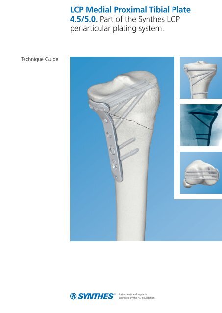 Medial tibial plateau plate