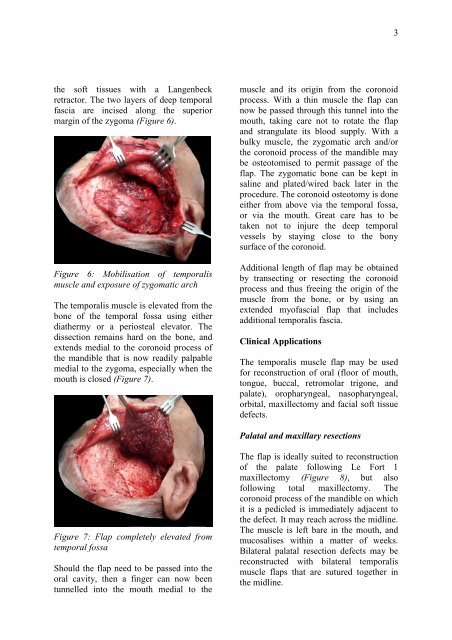 TEMPORALIS MUSCLE FLAP - Vula - University of Cape Town