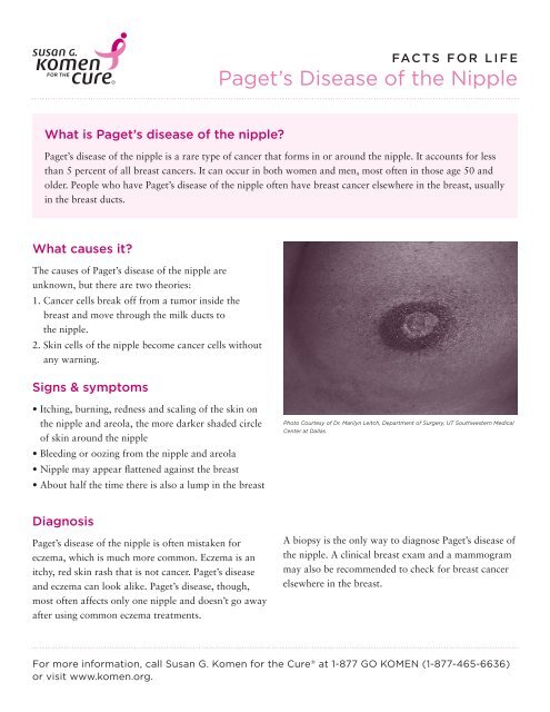 Paget's disease of the breast