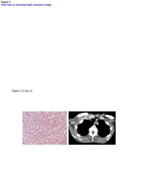 Thyroid carcinomas incidentally found in the cervical lymph nodes ...