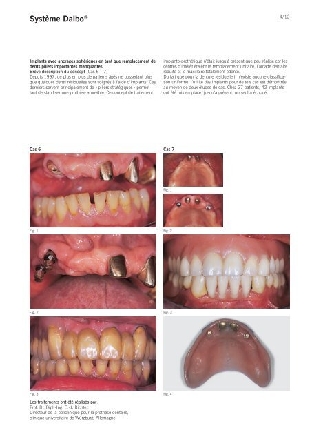 +Dalbo®-System sur implants et racines robuste ... - Cendres Métaux