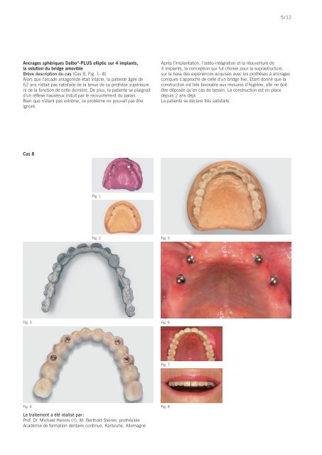 +Dalbo®-System sur implants et racines robuste ... - Cendres Métaux