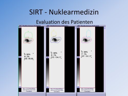 SIRT aus der Sicht des Nuklearmediziners