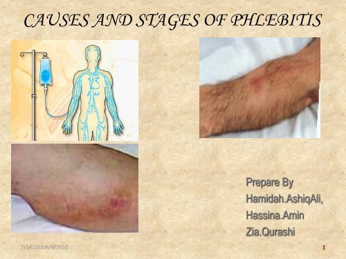 Causes And Stages Of Phlebitis Iupui