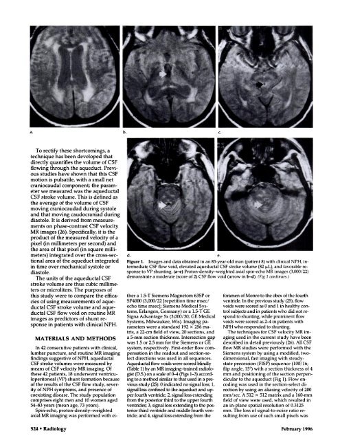 Normal-Pressure Hydrocephalus - International Hydrocephalus ...