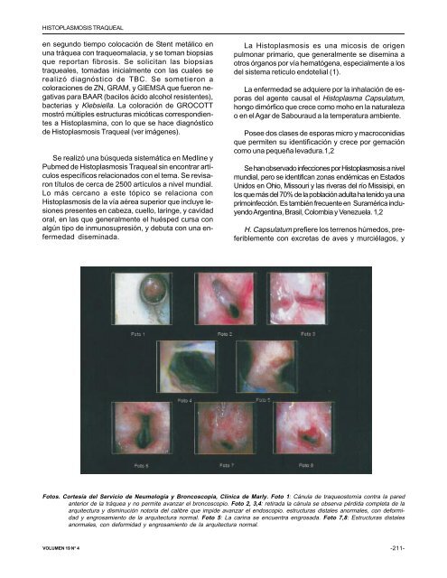 Histoplasmosis traqueal - Asoneumocito