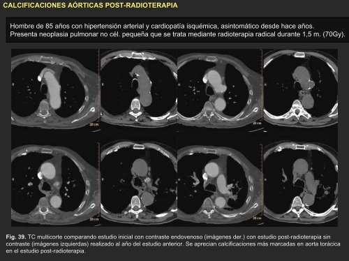 sarcoma de arteria pulmonar