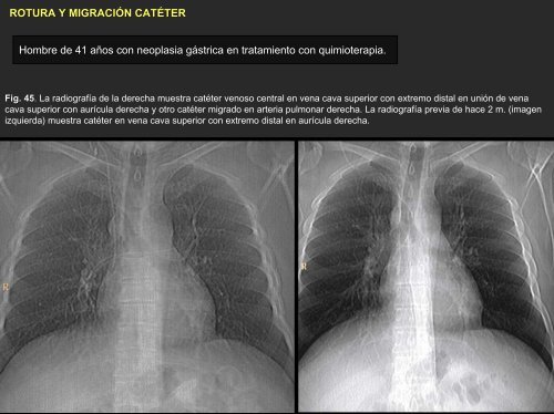 sarcoma de arteria pulmonar