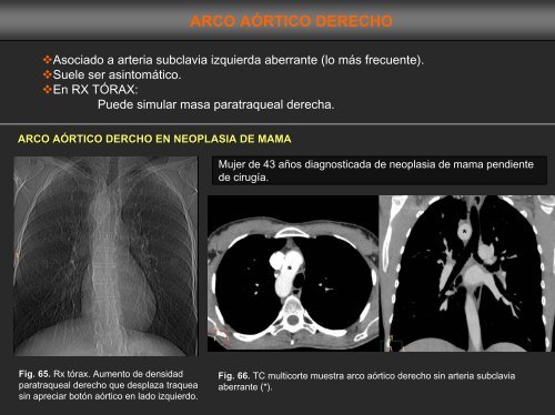 sarcoma de arteria pulmonar