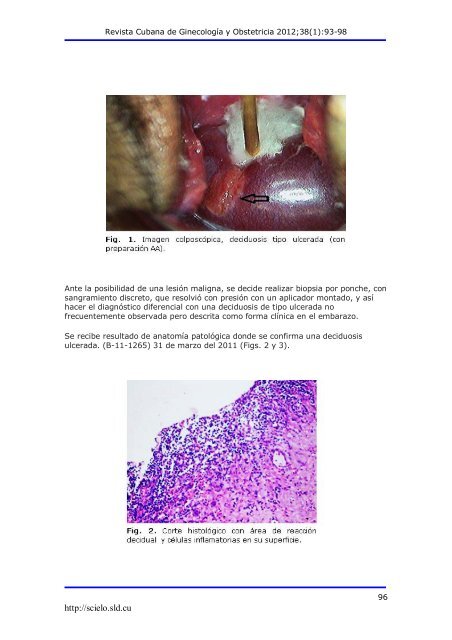 Deciduosis ulcerada y embarazo - SciELO