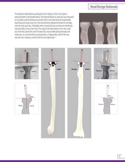 Anatomic Radial Head System Brochure and Surgical Technique