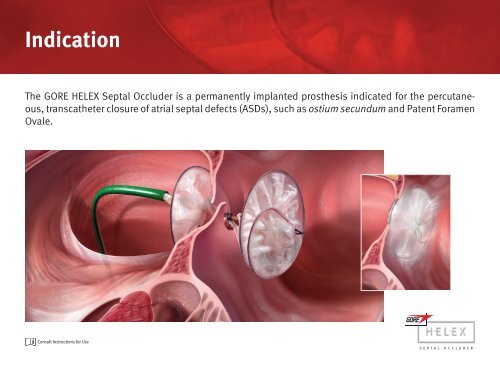 Physician-to-Physician Presentation - Gore Medical