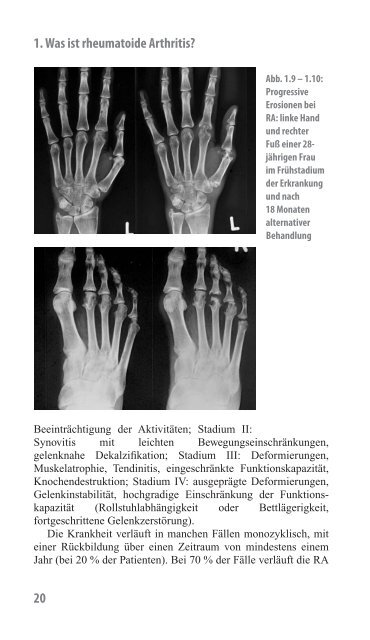 Rheumatoide Arthritis – ein Handbuch - Phadia